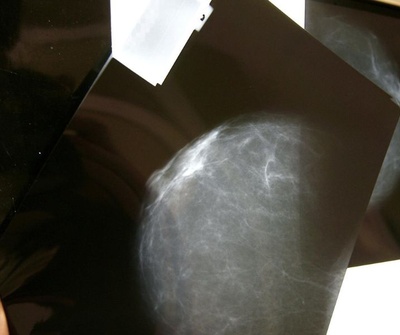 Un informe denuncia la inacción que ha "dejado atrás" pacientes con cáncer de pecho