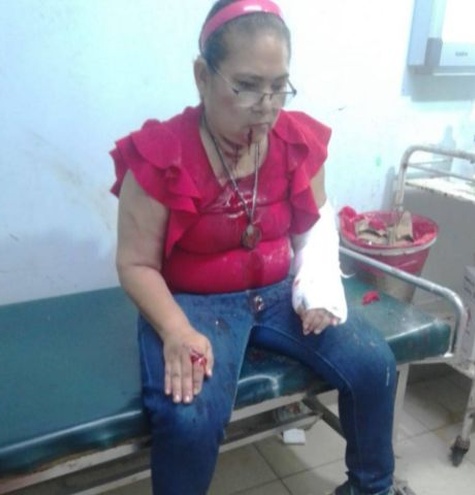 trabajadora ingenio san antonio chinandega herida brazos