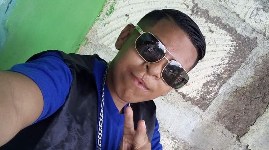 “Miguelito”, un joven nicaragüense que nació con labio leporino busca grabar video musical en Guatemala