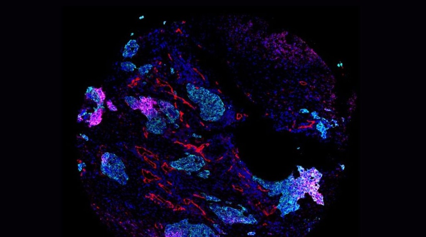 El mapa más amplio del cáncer de pulmón pone el foco en la diversidad tumoral