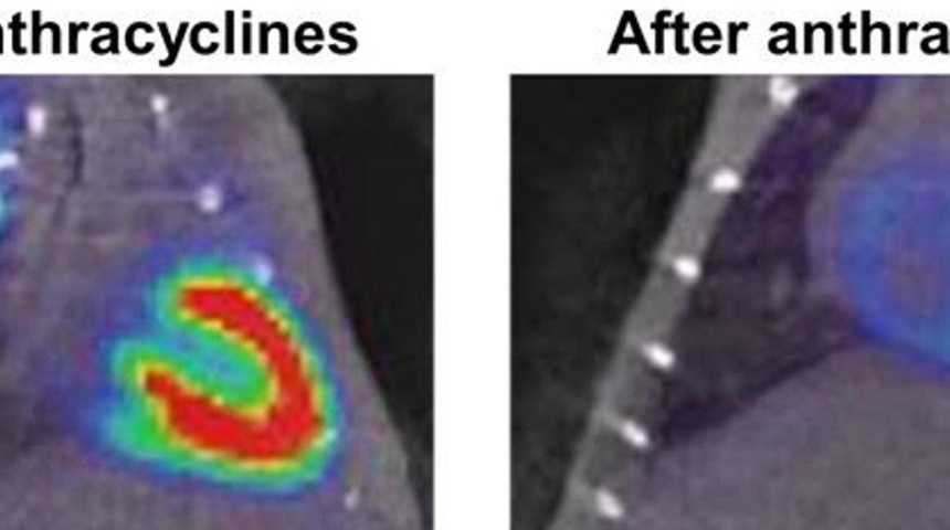 Hallan una posible vía para remediar el daño al corazón de la medicación contra el cáncer