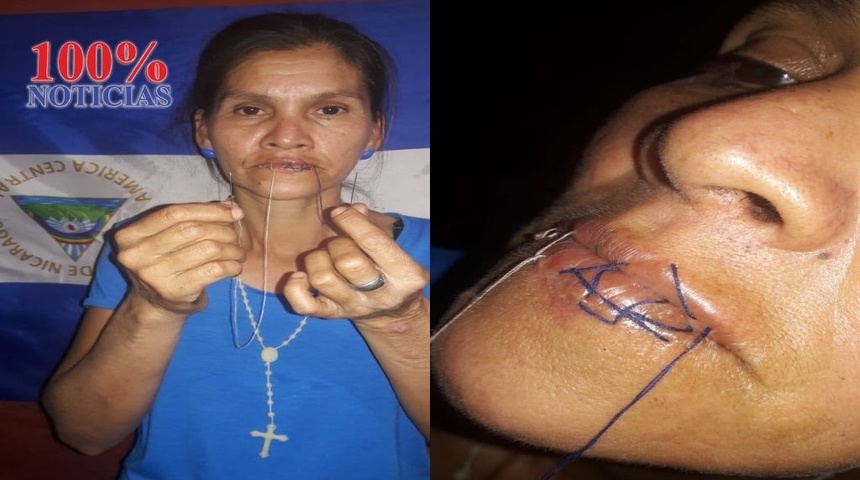 Madre de excarcelado se cose labios para exigir libertad por presos políticos en Nicaragua