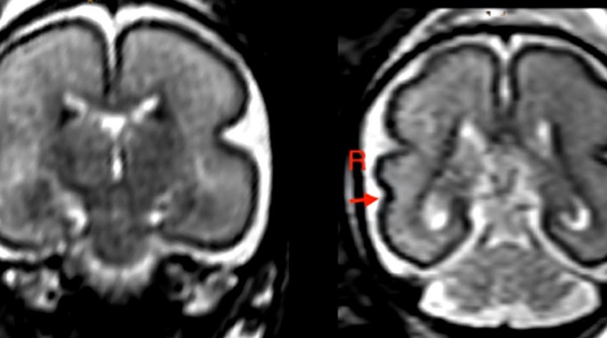 Beber en el embarazo, incluso poco, produce cambios en el cerebro del bebé